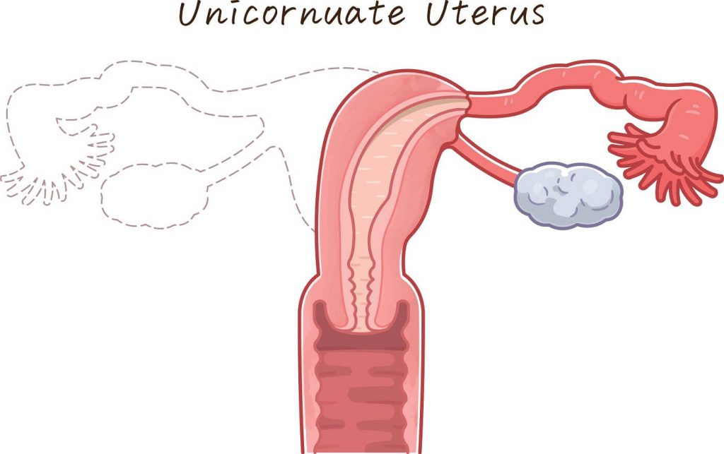 Útero Unicorne Qué Es Y Cómo Influye En El Embarazo 5774