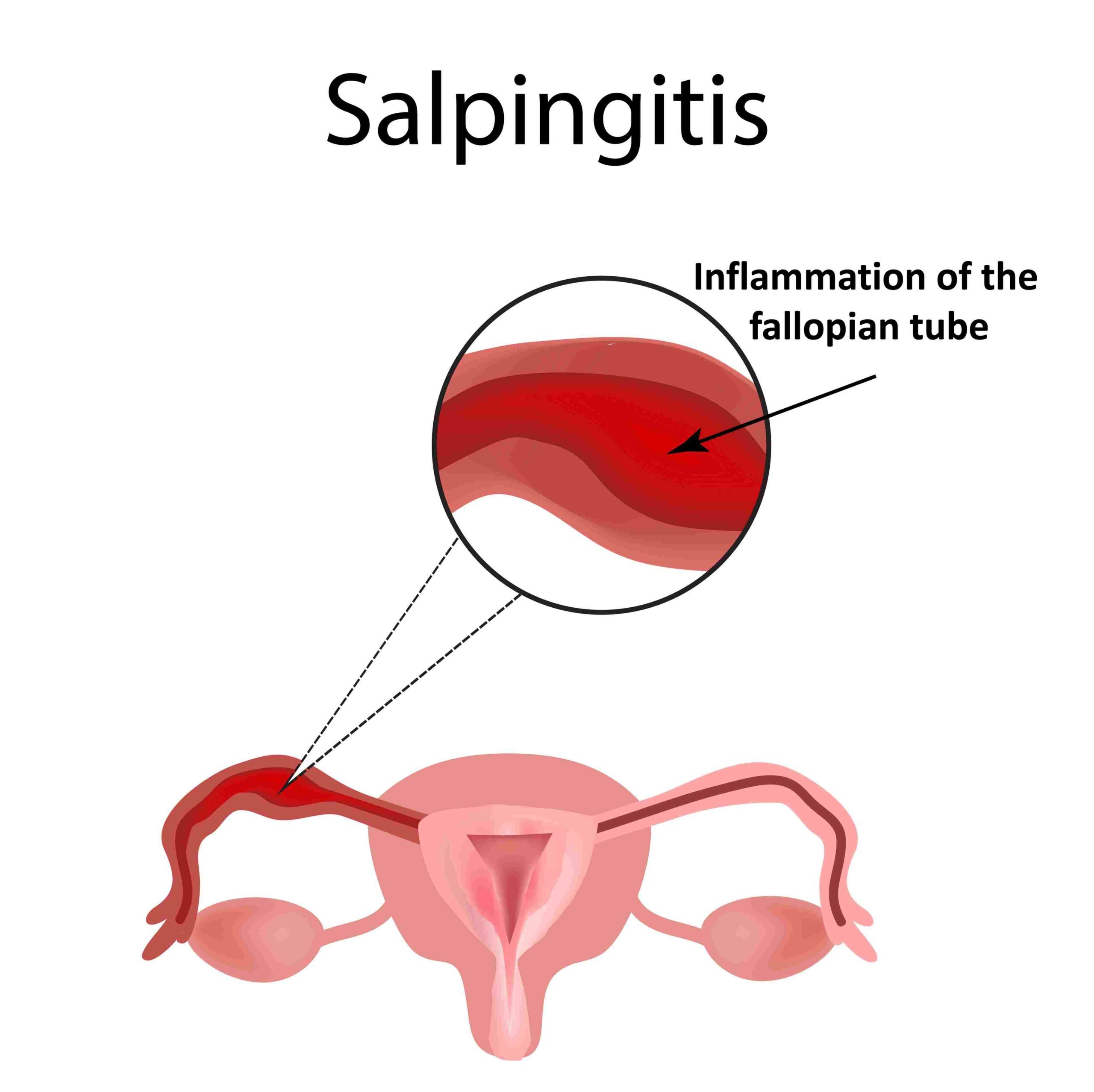 Salpingitis