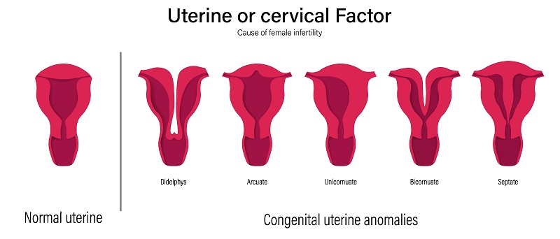 utero arcuato